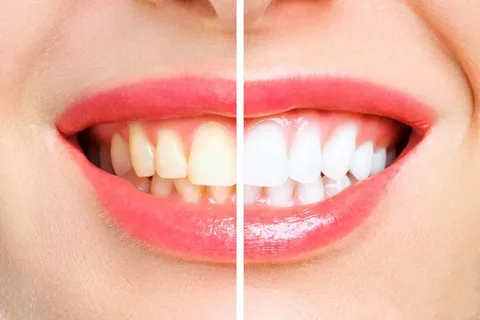 10 Expert Teeth Whitening Tips for a Brighter, Longer-Lasting Smile