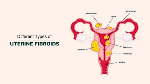 Uterine Fibroids and Cancer: What You Need to Know